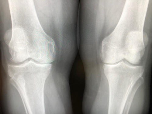 Arthrosebehandlung am Knie